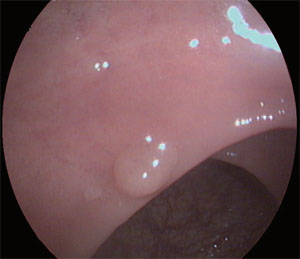Эндоскопическое изображение полипа полученное с помощью VME-2000