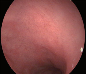 Эндоскопическое изображение участка воспаления, полученное с помощью VME-2000
