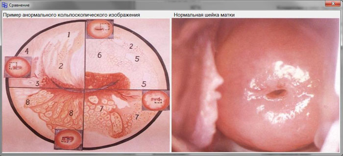 Сравнение кольпоскопических снимков в программе GynLab