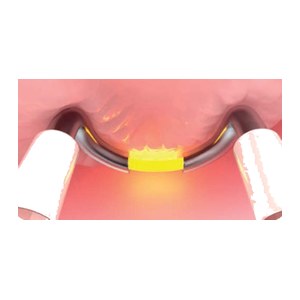 Электроды биполярные одноразовые TruBipolar Plasma EDGE для резекции, вапоризации и энуклеации