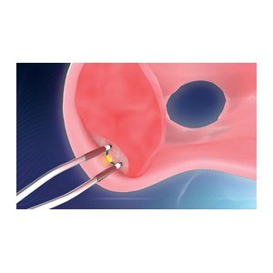 Электроды биполярные одноразовые TruBipolar Plasma EDGE для резекции, вапоризации и энуклеации